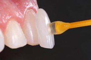 Lente Dental em Bento Gonçalves Lente Dental em Bento Gonçalves